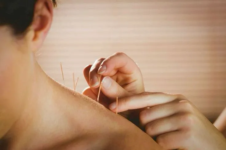 Acupuncture Treatment
