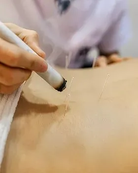 Moxibustion